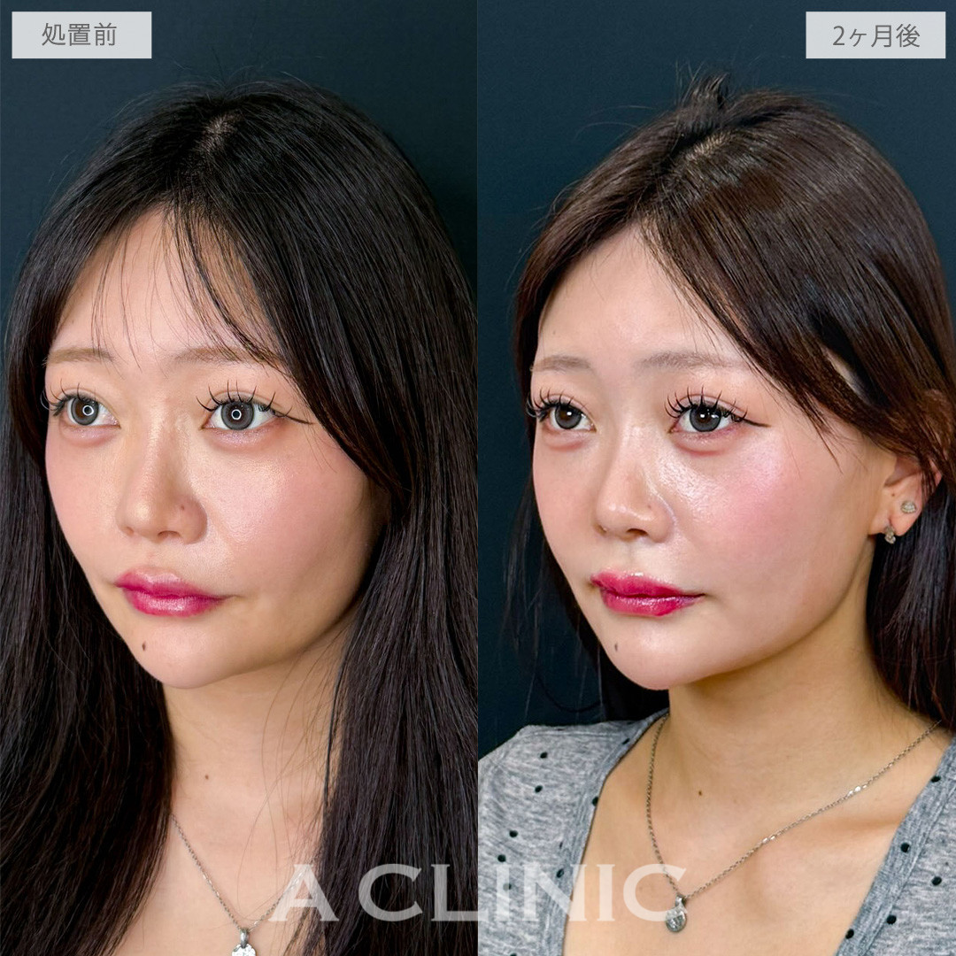 1day小顔脂肪吸引でキュッと引き締まった垢抜け小顔へ！こちら処置前と2か月後の症例です(20代女性)