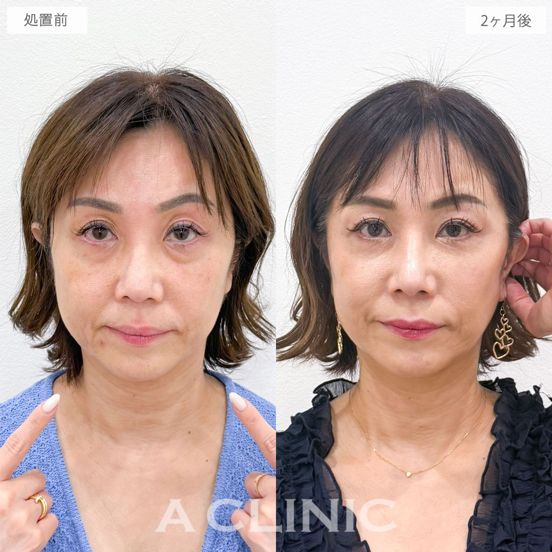 A式ナゾラリフトで品のある自然な若々しさを取り戻しました！こちら処置前から2か月後の症例です(50代女性)