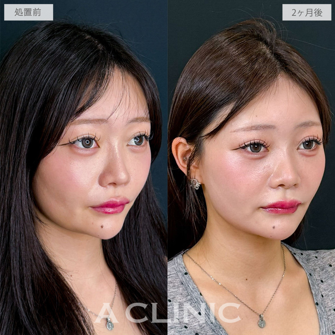 1day小顔脂肪吸引でキュッと引き締まった垢抜け小顔へ！こちら処置前と2か月後の症例です(20代女性)