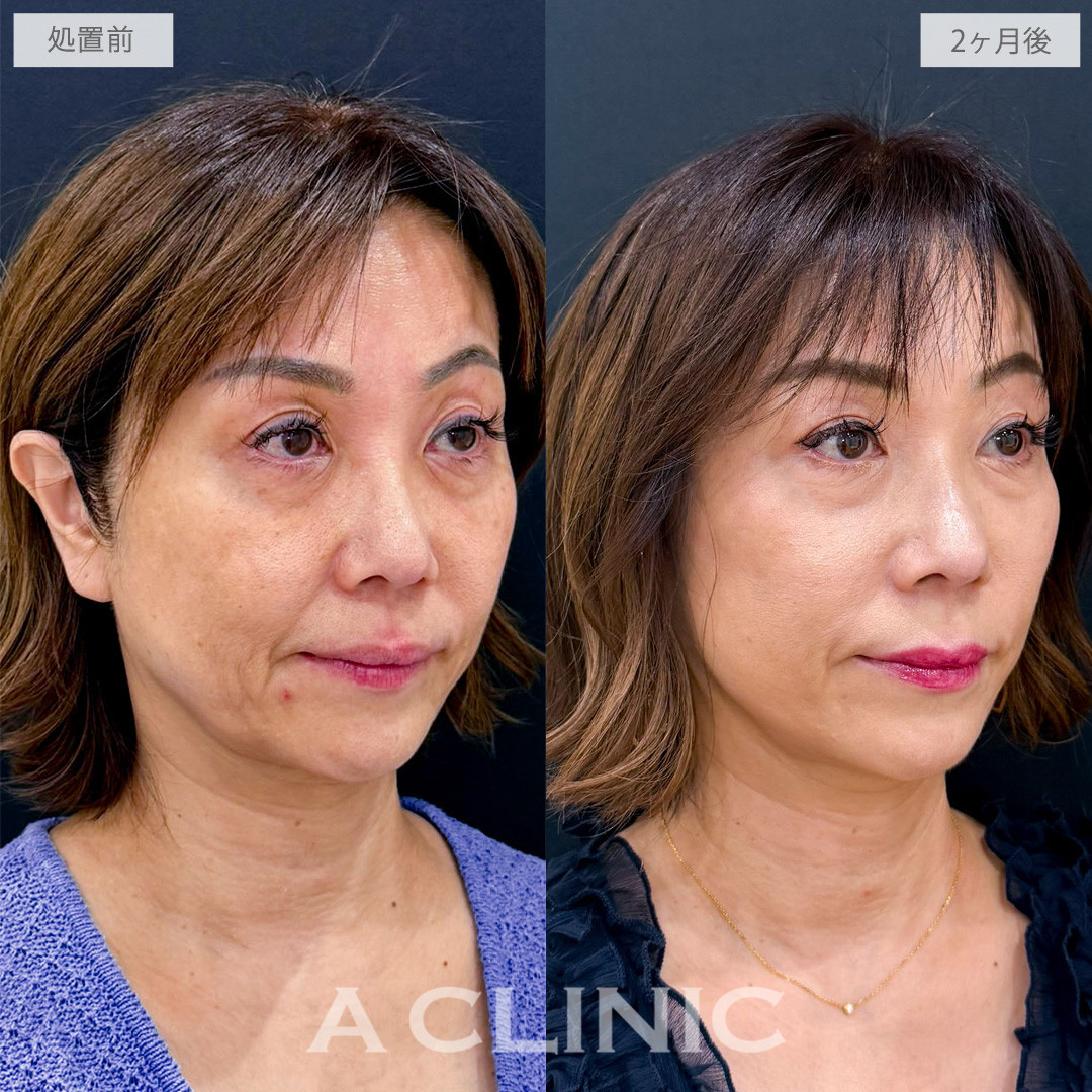 A式ナゾラリフトで品のある自然な若々しさを取り戻しました！こちら処置前から2か月後の症例です(50代女性)