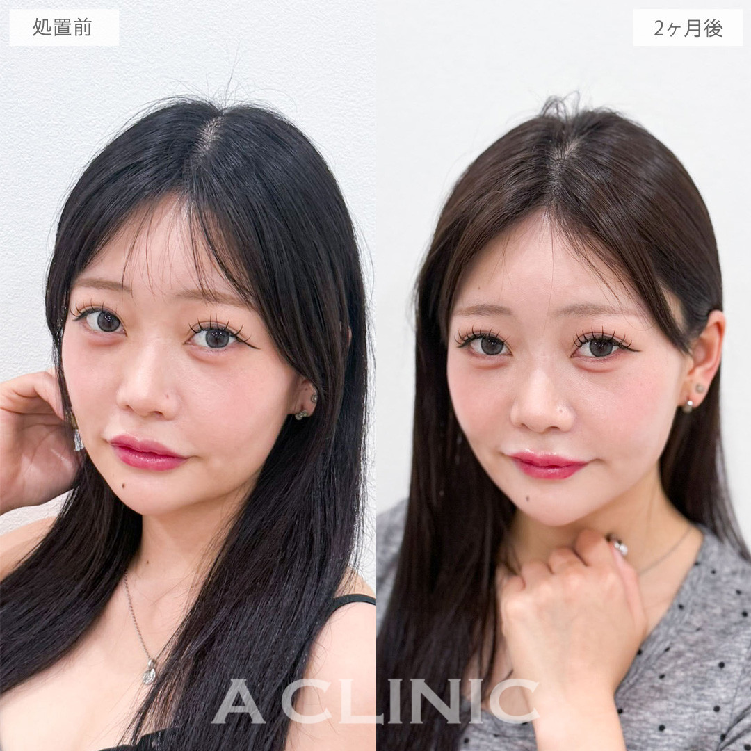 1day小顔脂肪吸引でキュッと引き締まった垢抜け小顔へ！こちら処置前と2か月後の症例です(20代女性)