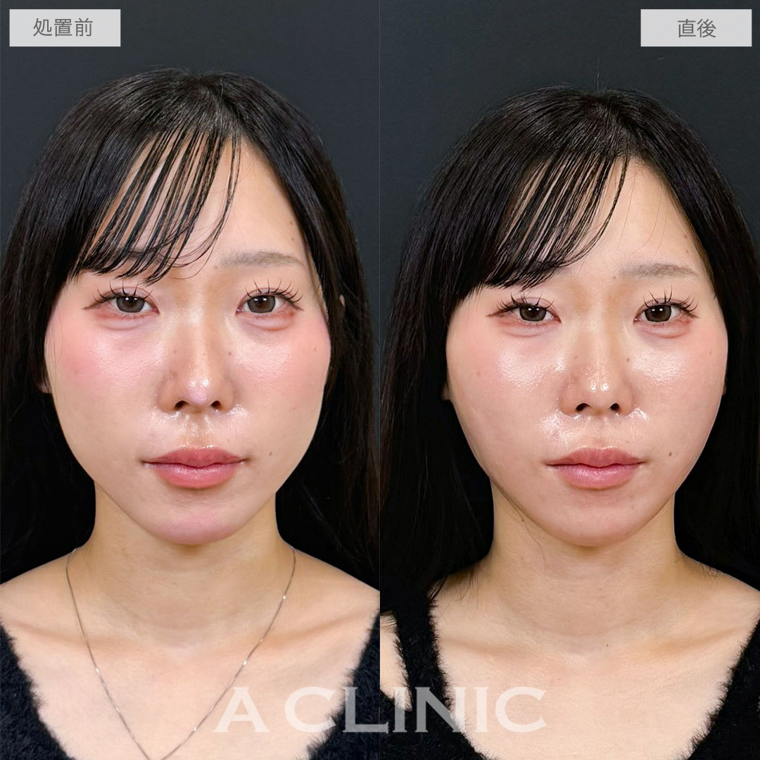 1day小顔脂肪吸引は術後すぐからキレイが叶う腫れの少ない脂肪吸引です！こちら処置前と直後の症例です(20代女性)