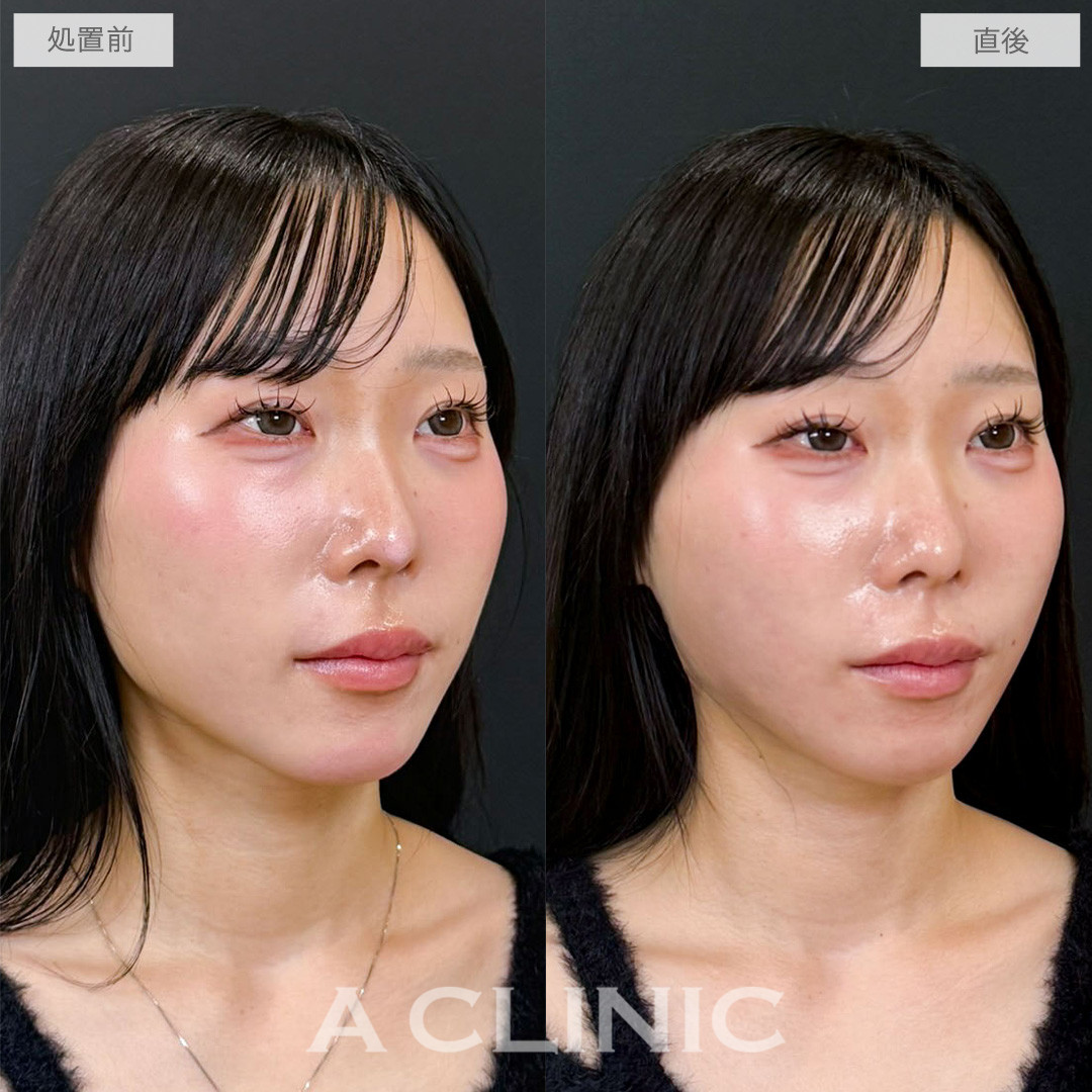 1day小顔脂肪吸引は術後すぐからキレイが叶う腫れの少ない脂肪吸引です！こちら処置前と直後の症例です(20代女性)