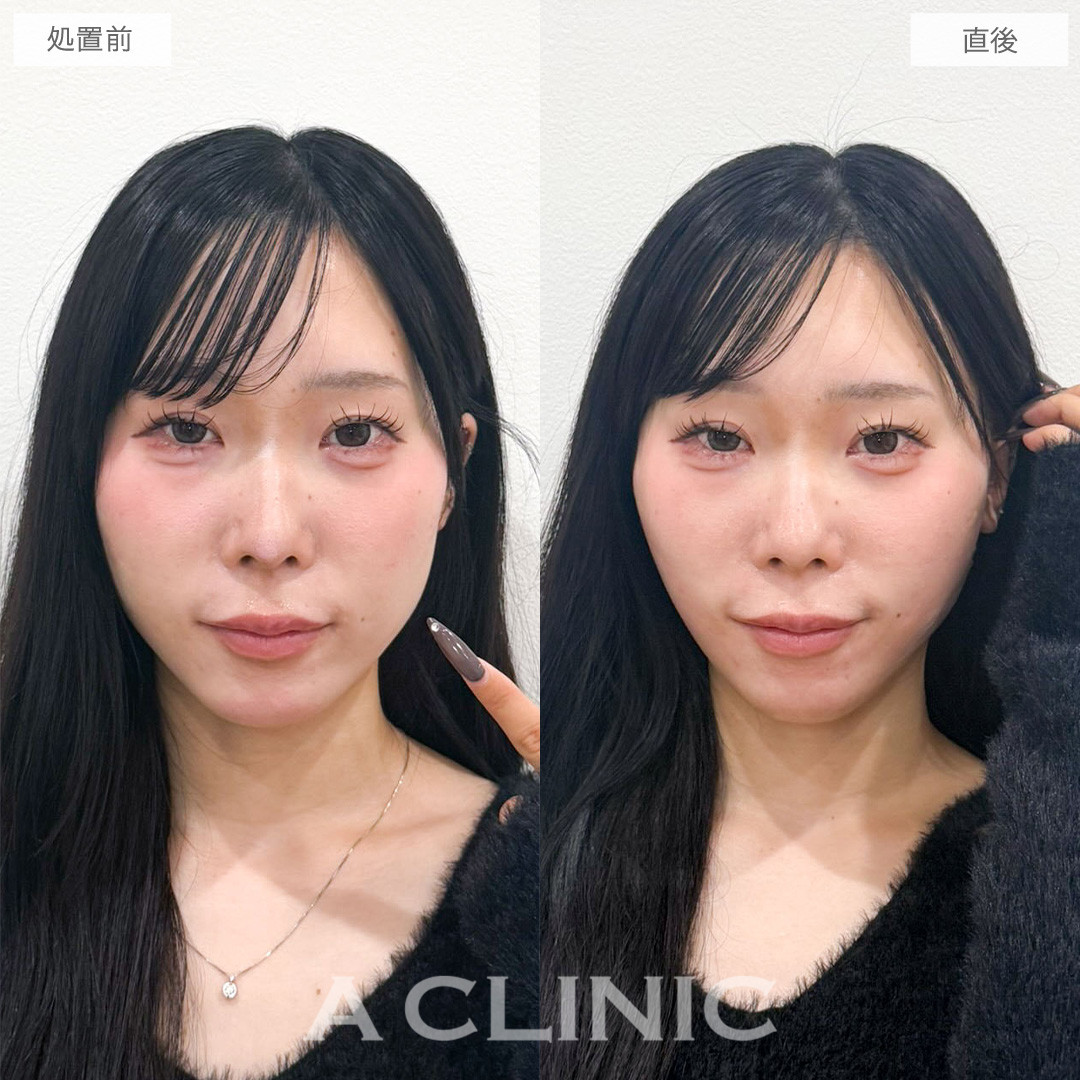 1day小顔脂肪吸引は術後すぐからキレイが叶う腫れの少ない脂肪吸引です！こちら処置前と直後の症例です(20代女性)