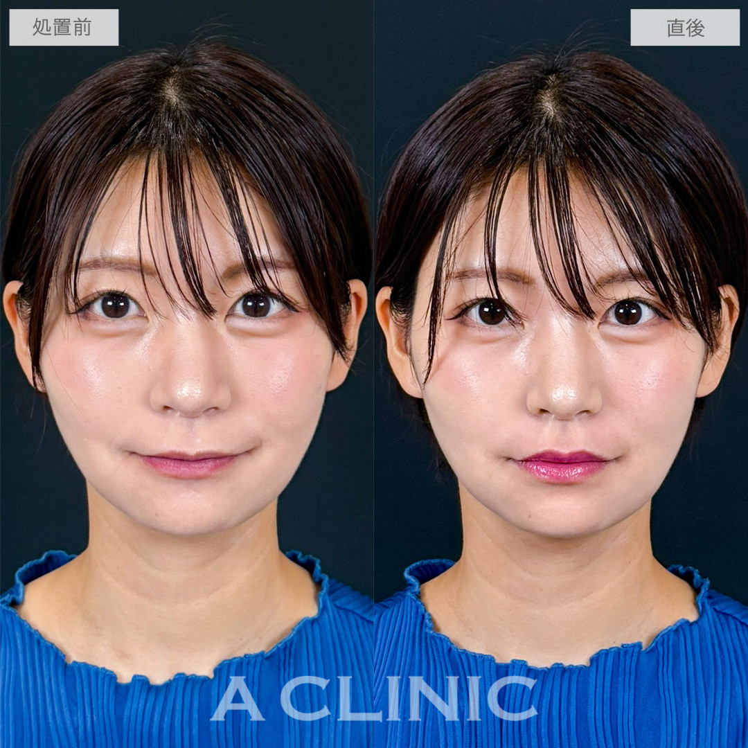スマイルリップでリップの存在感をさりげなくUP！こちら処置前と直後の症例です(20代女性)