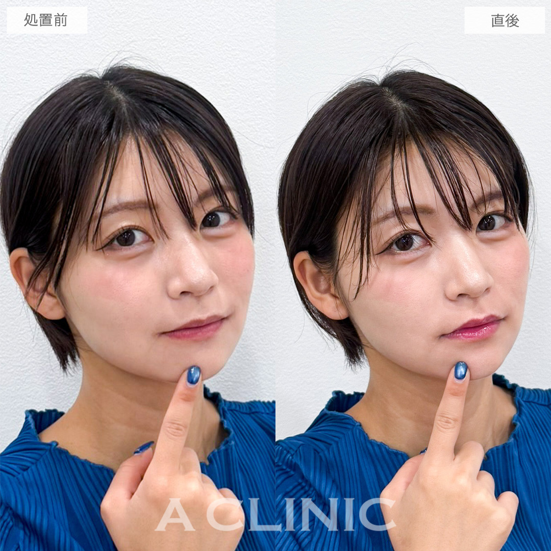 スマイルリップでリップの存在感をさりげなくUP！こちら処置前と直後の症例です(20代女性)