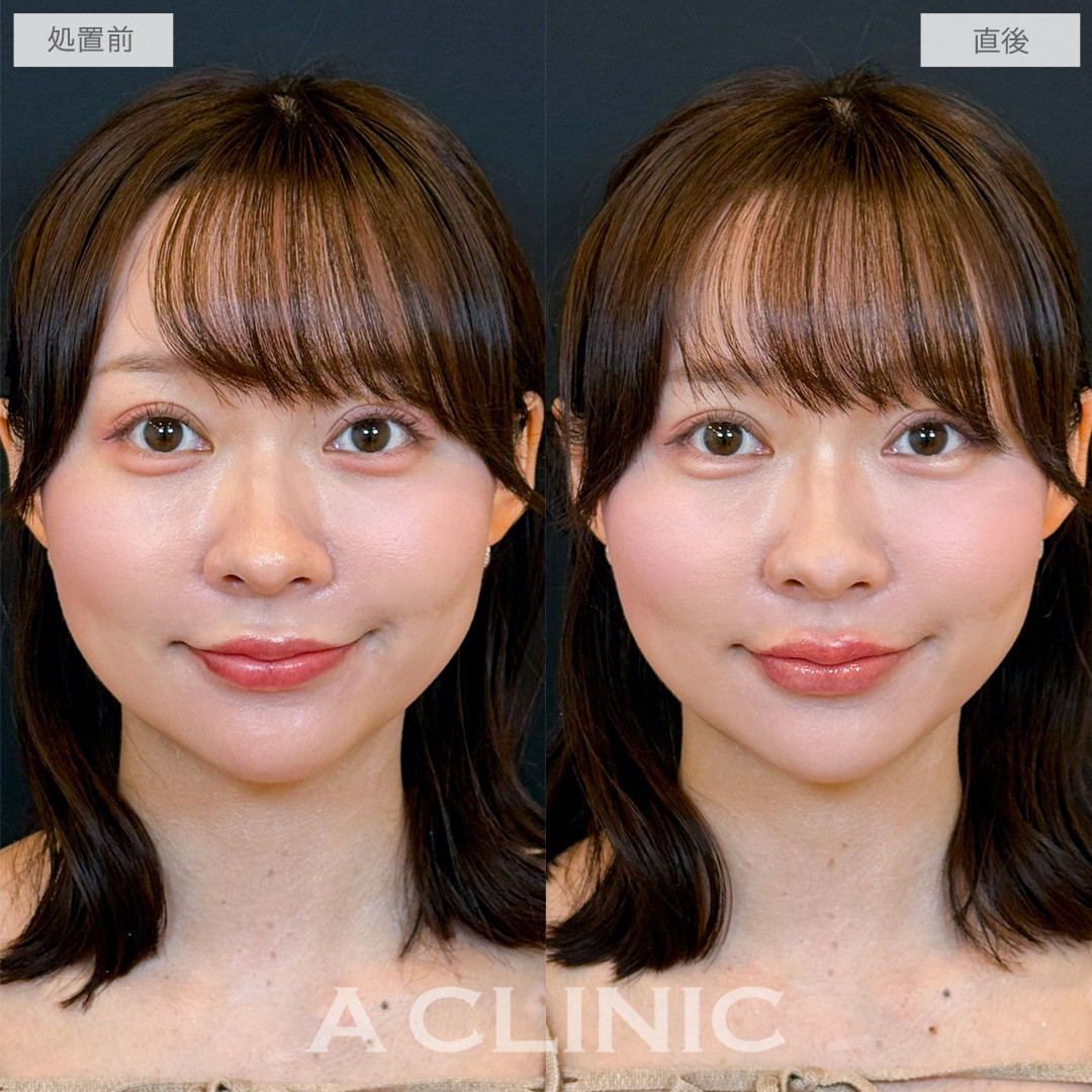 スマイルリップで薄唇の悩みを解消して多幸感UP！こちら処置前と直後の症例です(20代女性)