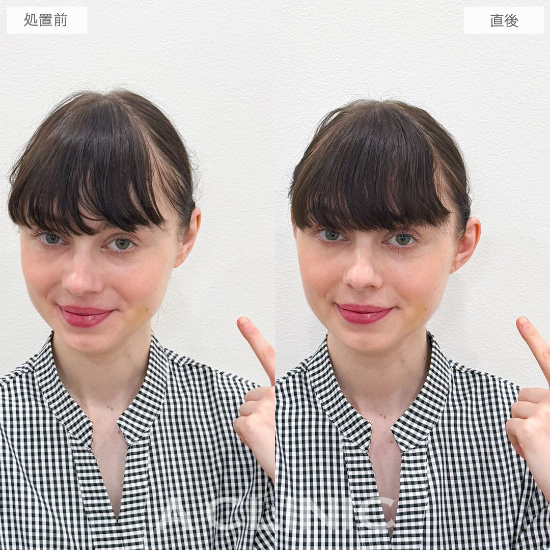 立ち耳ヒアルロン酸注入(ボリューマ)は輪郭のVラインが強調され中顔面短縮効果もある施術です！こちら処置前と直後の症例です(30代女性)
