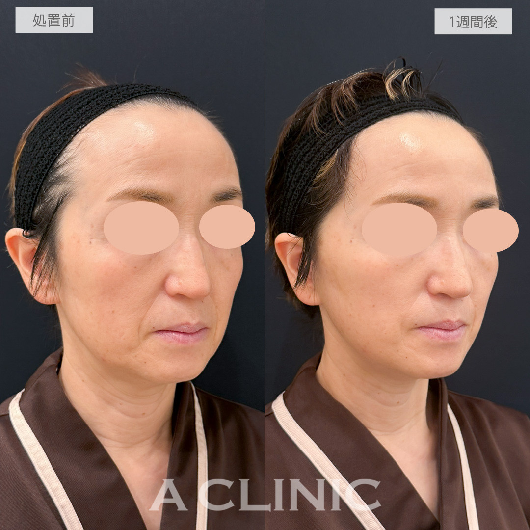 A式たるみ切開で腫れも気にならずにさりげなく若返ることができました！処置前と1週間後の症例です(50代女性)