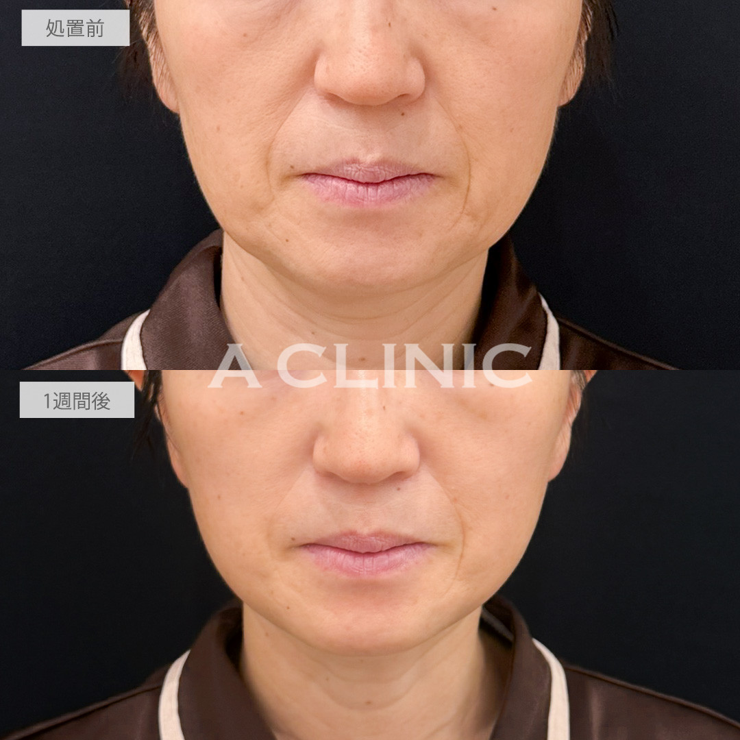A式たるみ切開で腫れも気にならずにさりげなく若返ることができました！処置前と1週間後の症例です(50代女性)