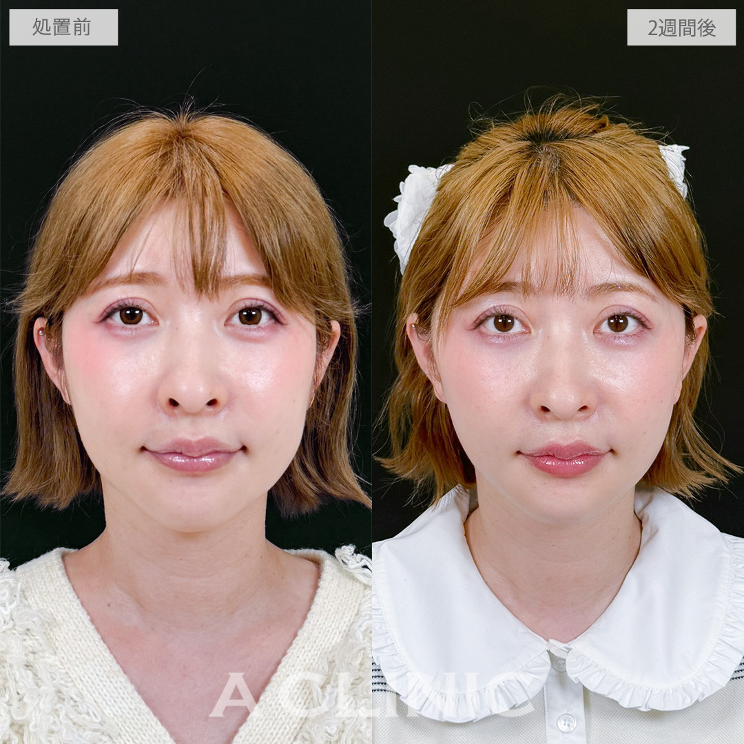 【直後の傷跡あり】A式たるみ切開で自然なリフトアップで若返りを実現！処置前と2週間後の症例です(40代女性)