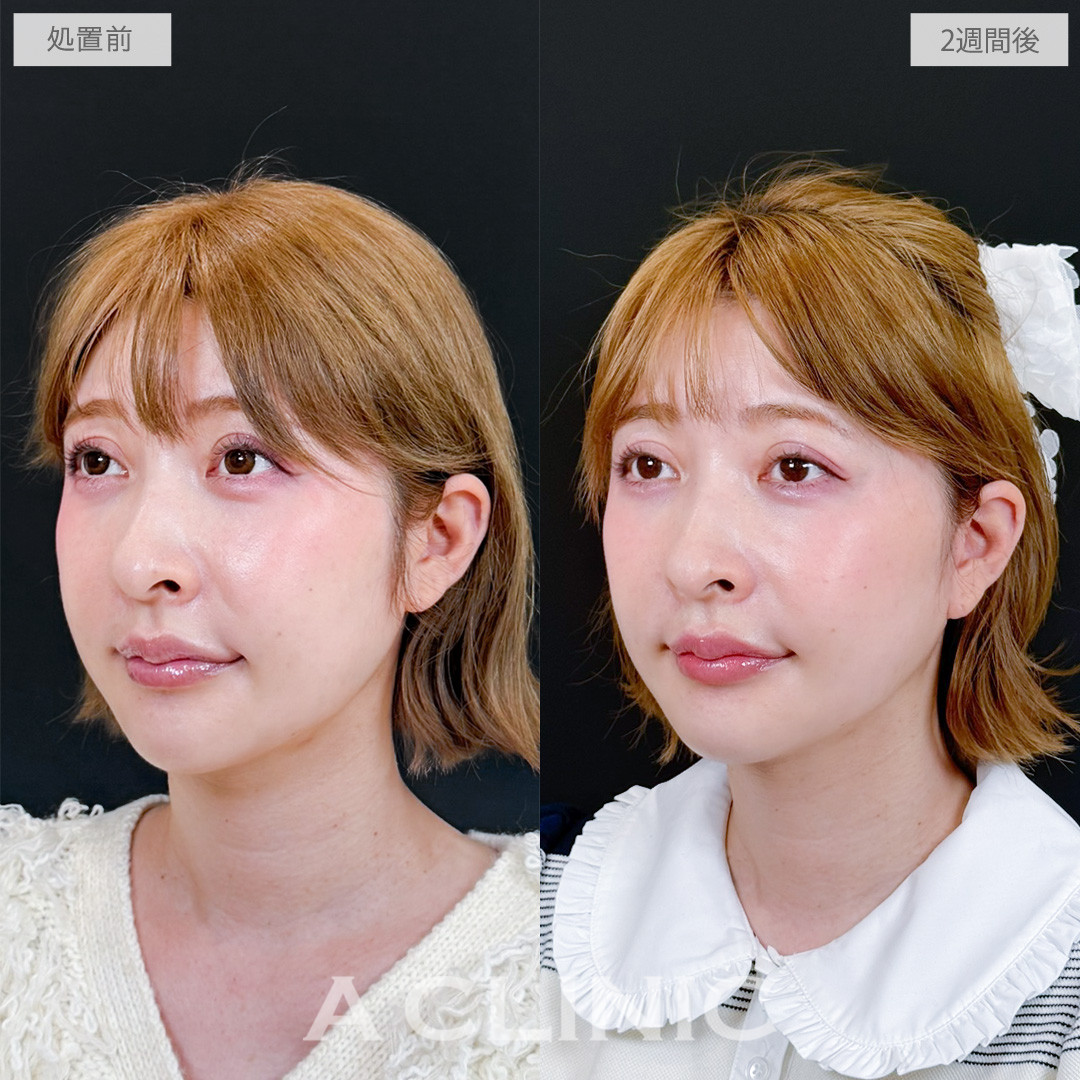 【直後の傷跡あり】A式たるみ切開で自然なリフトアップで若返りを実現！処置前と2週間後の症例です(40代女性)
