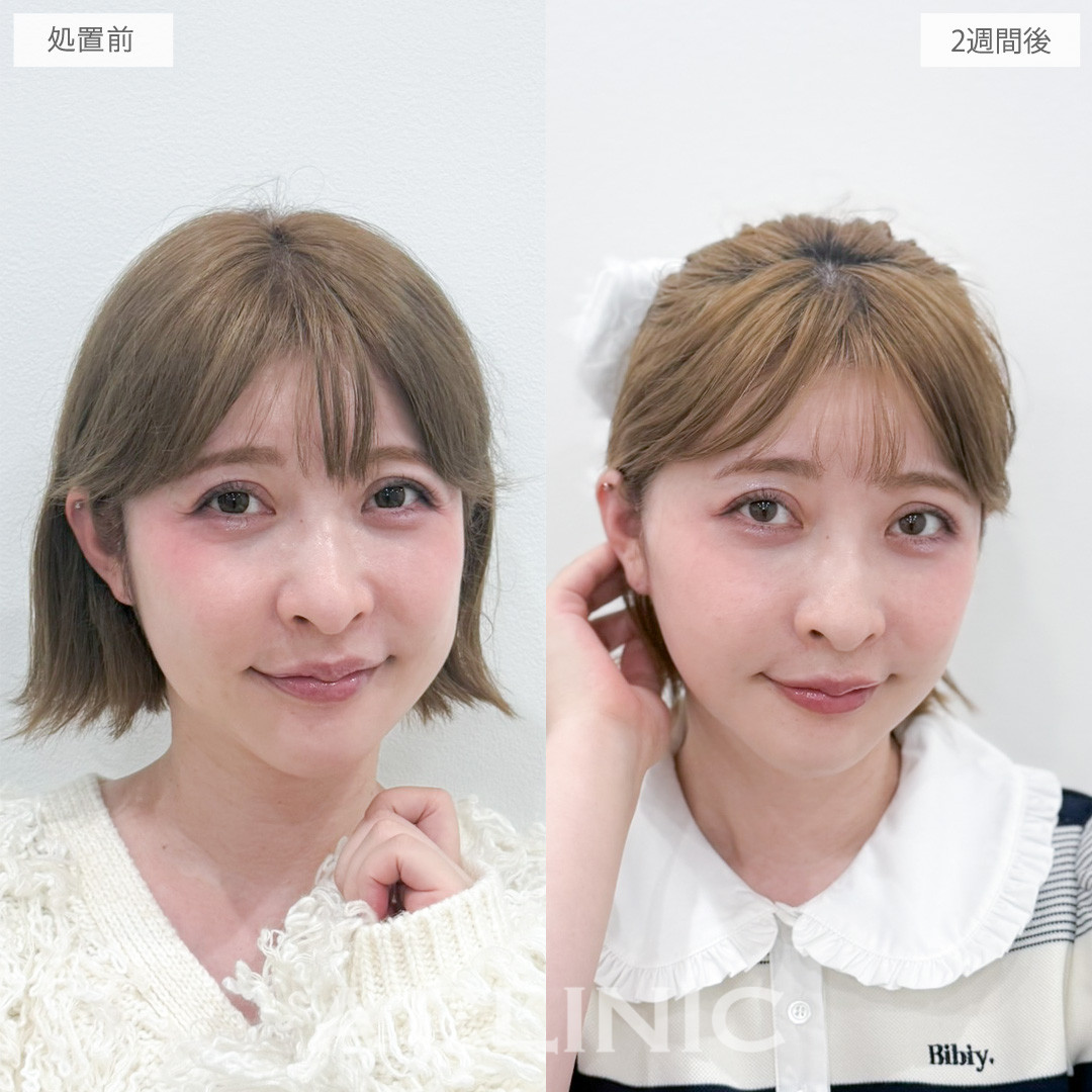 【直後の傷跡あり】A式たるみ切開で自然なリフトアップで若返りを実現！処置前と2週間後の症例です(40代女性)