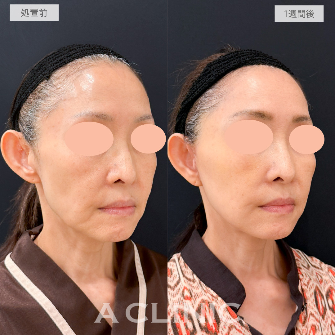 【直後の傷跡あり】A式たるみ切開で口元のもたつき改善ができナチュラルに若返り！処置前と1週間後の症例です(50代女性)