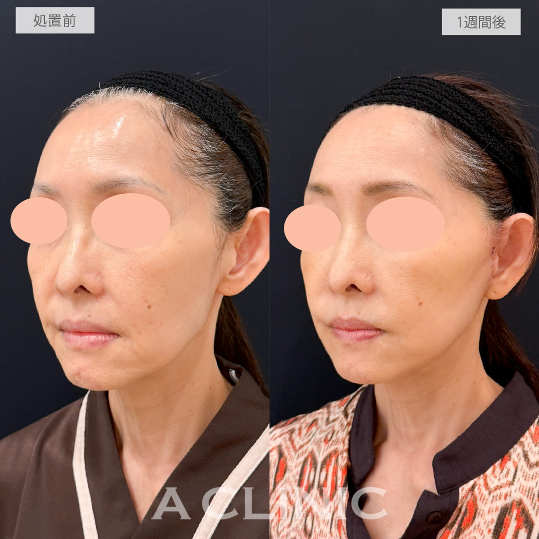 【直後の傷跡あり】A式たるみ切開で口元のもたつき改善ができナチュラルに若返り！処置前と1週間後の症例です(50代女性)