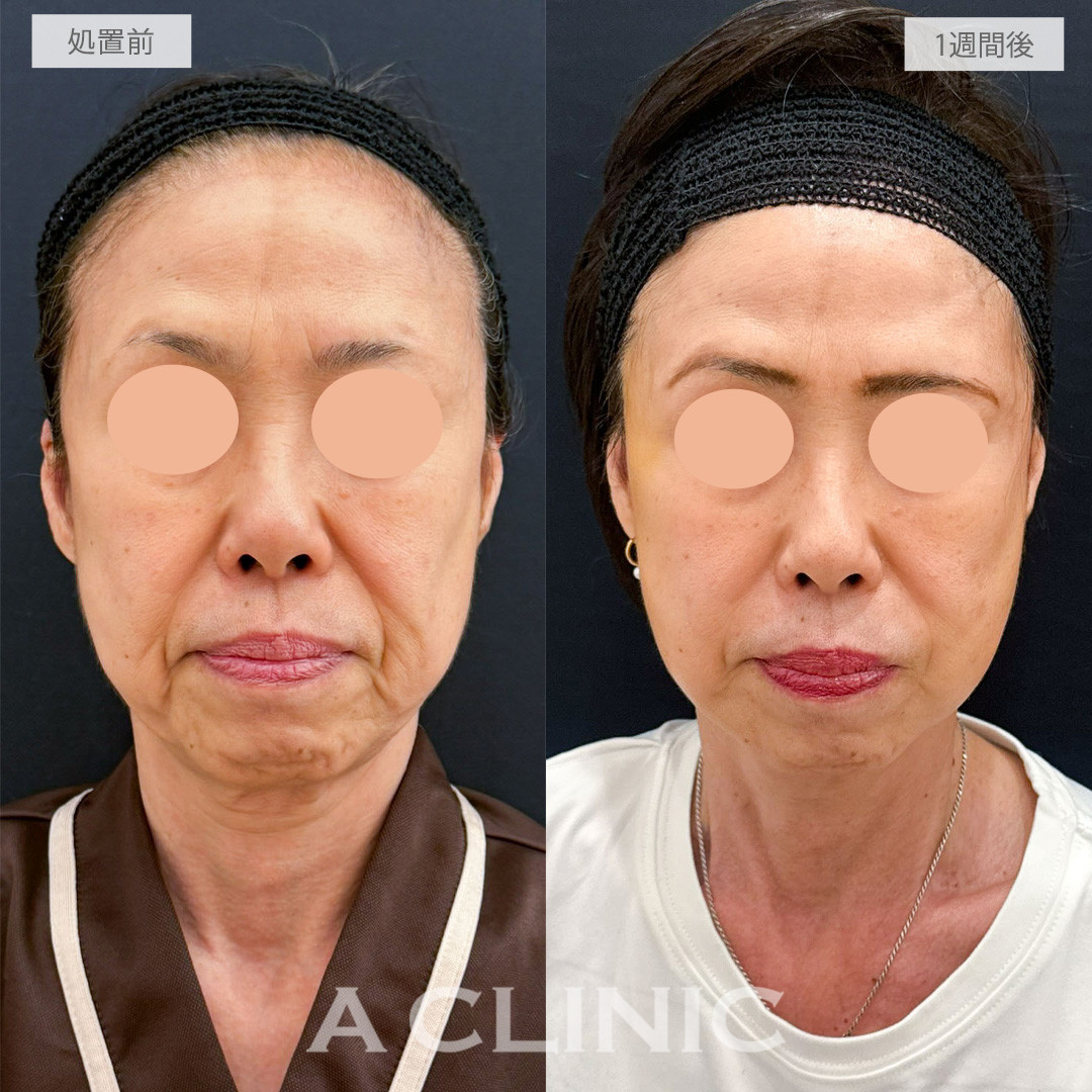 A式たるみ切開で品格のある自然で若々しい輪郭へ！こちら処置前から1週間後の症例です(60代女性)