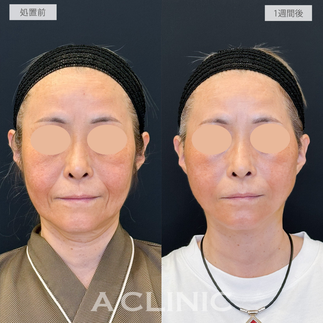 A式たるみ切開でたるみとしわを一気に目立たなくなりつるッとしたフェイスに！処置前と1週間後の症例です(50代女性)