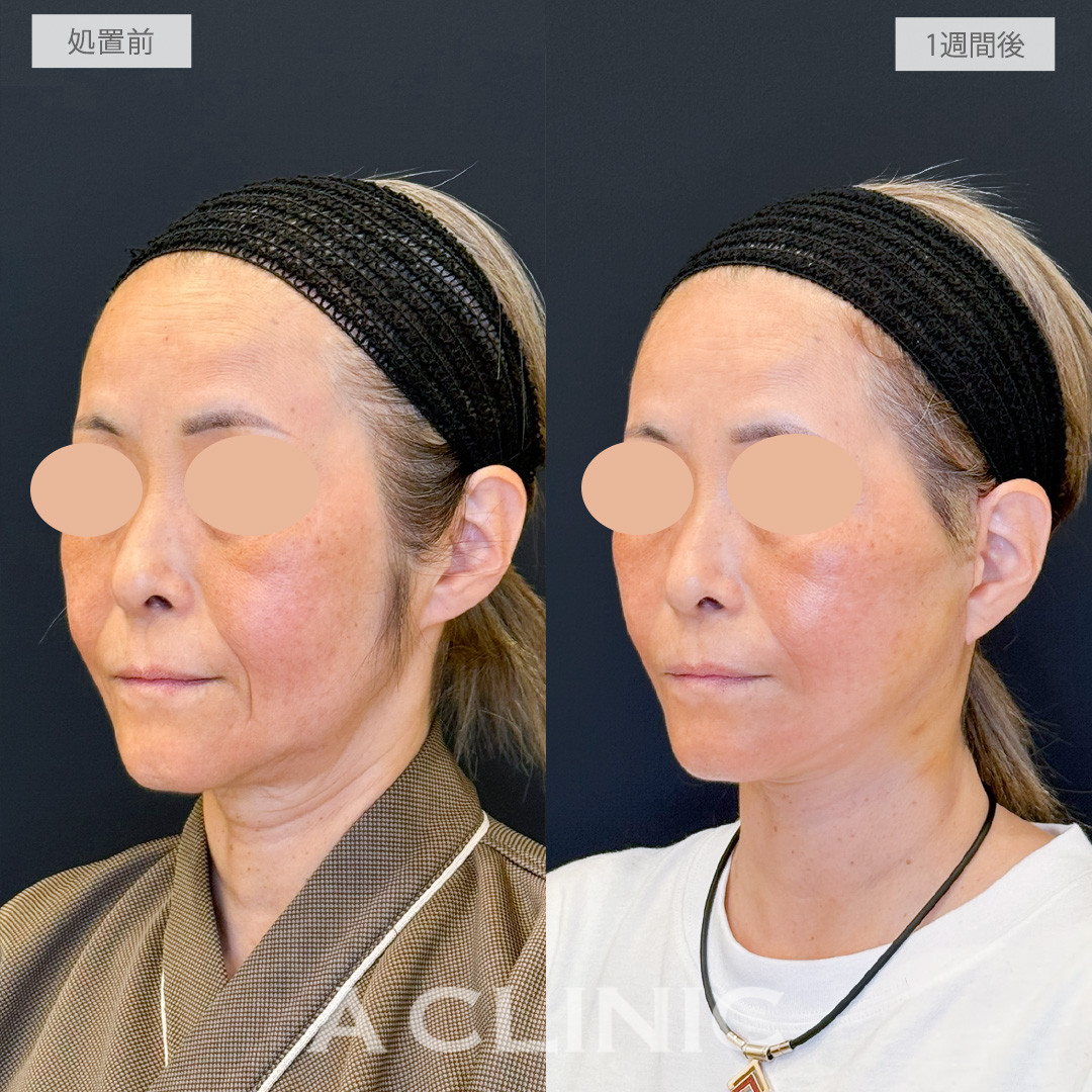 A式たるみ切開でたるみとしわを一気に目立たなくなりつるッとしたフェイスに！処置前と1週間後の症例です(50代女性)