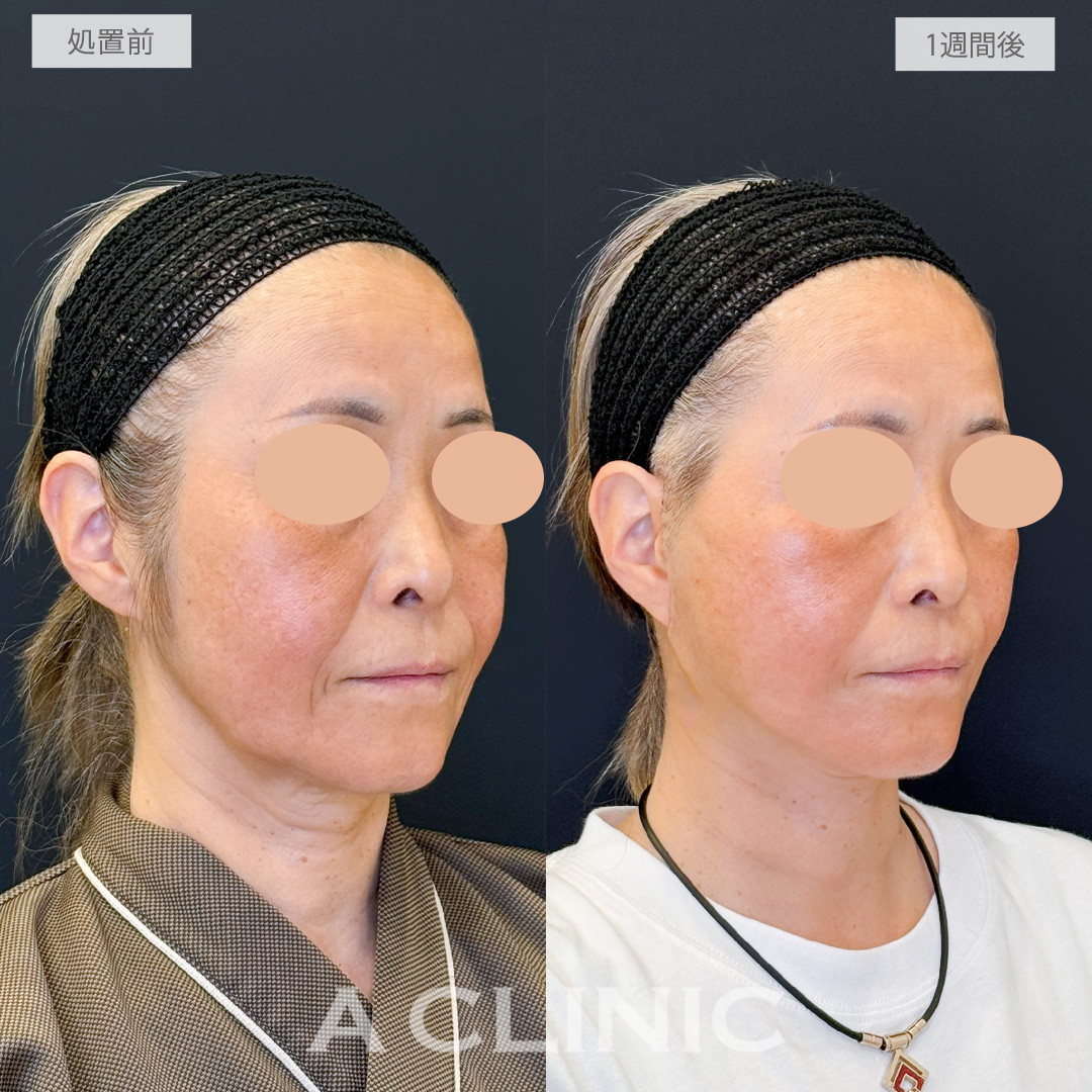 A式たるみ切開でたるみとしわを一気に目立たなくなりつるッとしたフェイスに！処置前と1週間後の症例です(50代女性)
