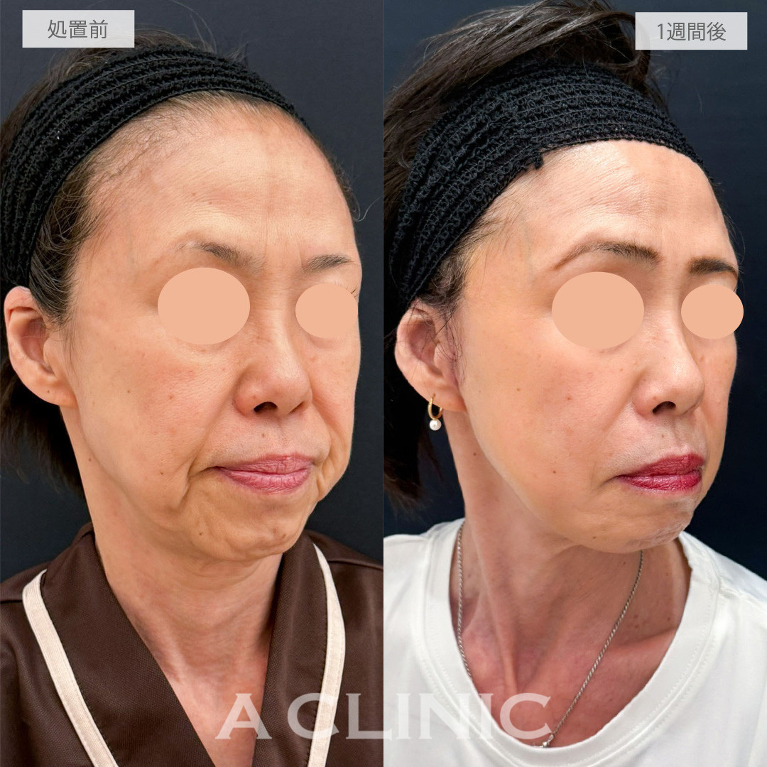 A式たるみ切開で品格のある自然で若々しい輪郭へ！こちら処置前から1週間後の症例です(60代女性)