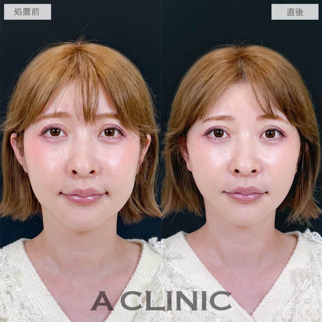 A式たるみ切開で直後でも腫れが気にならずにリフトアップ効果を実感！処置前と直後の症例です(40代女性)