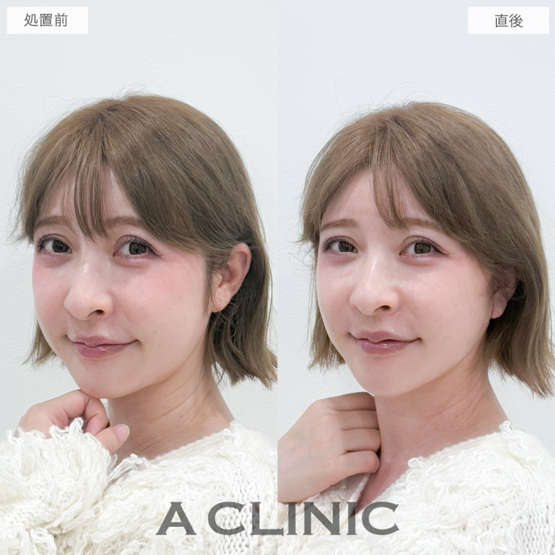 A式たるみ切開で直後でも腫れが気にならずにリフトアップ効果を実感！処置前と直後の症例です(40代女性)