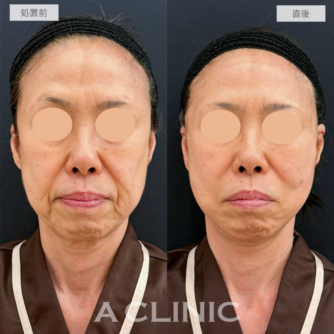 A式たるみ切開で品格のある自然で若々しい輪郭へ！こちら処置前から1週間後の症例です(60代女性)