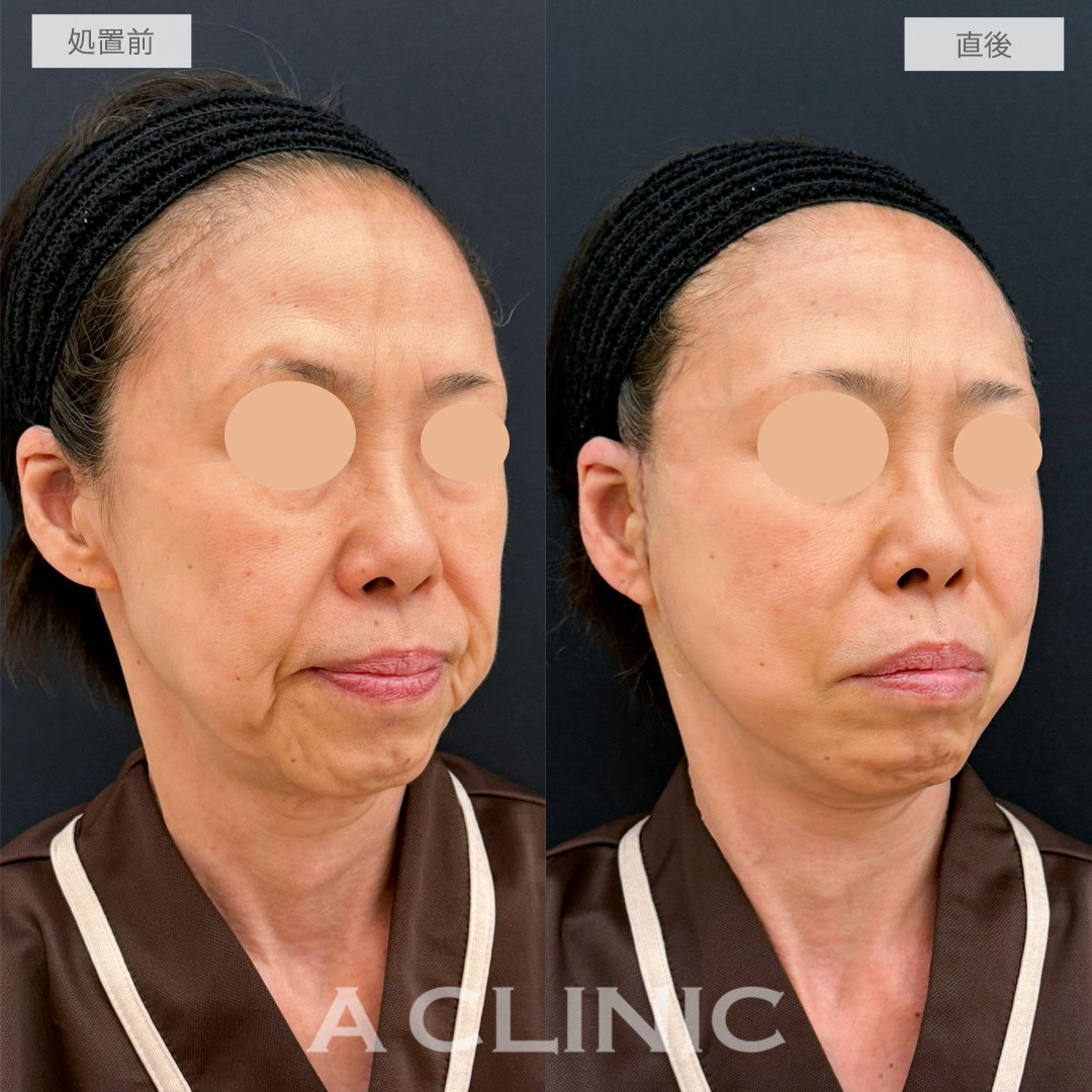 A式たるみ切開で品格のある自然で若々しい輪郭へ！こちら処置前から1週間後の症例です(60代女性)