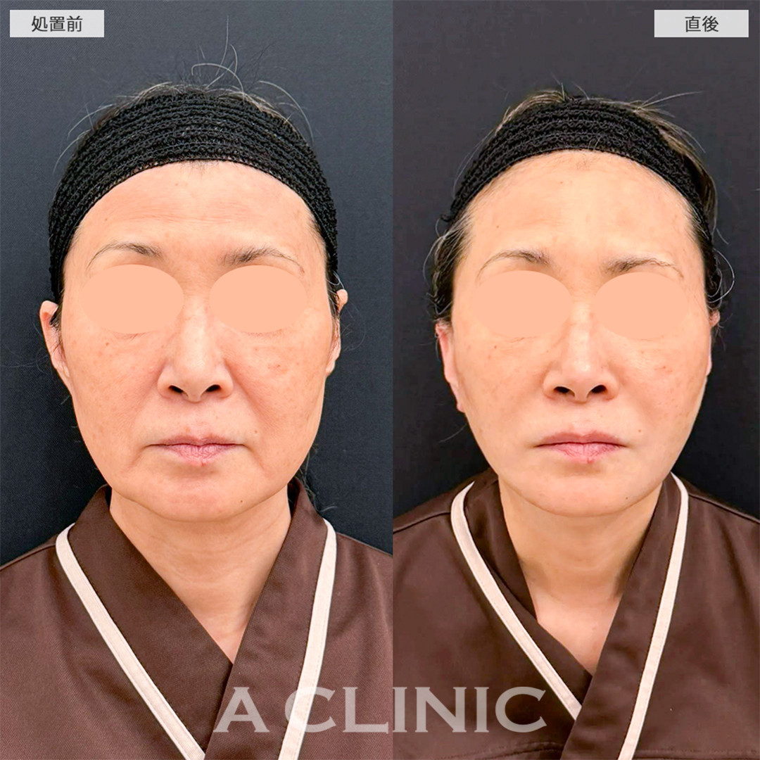 A式たるみ切開で直後から綺麗なフェイスラインになりました！こちら処置前と直後の症例です(60代女性)