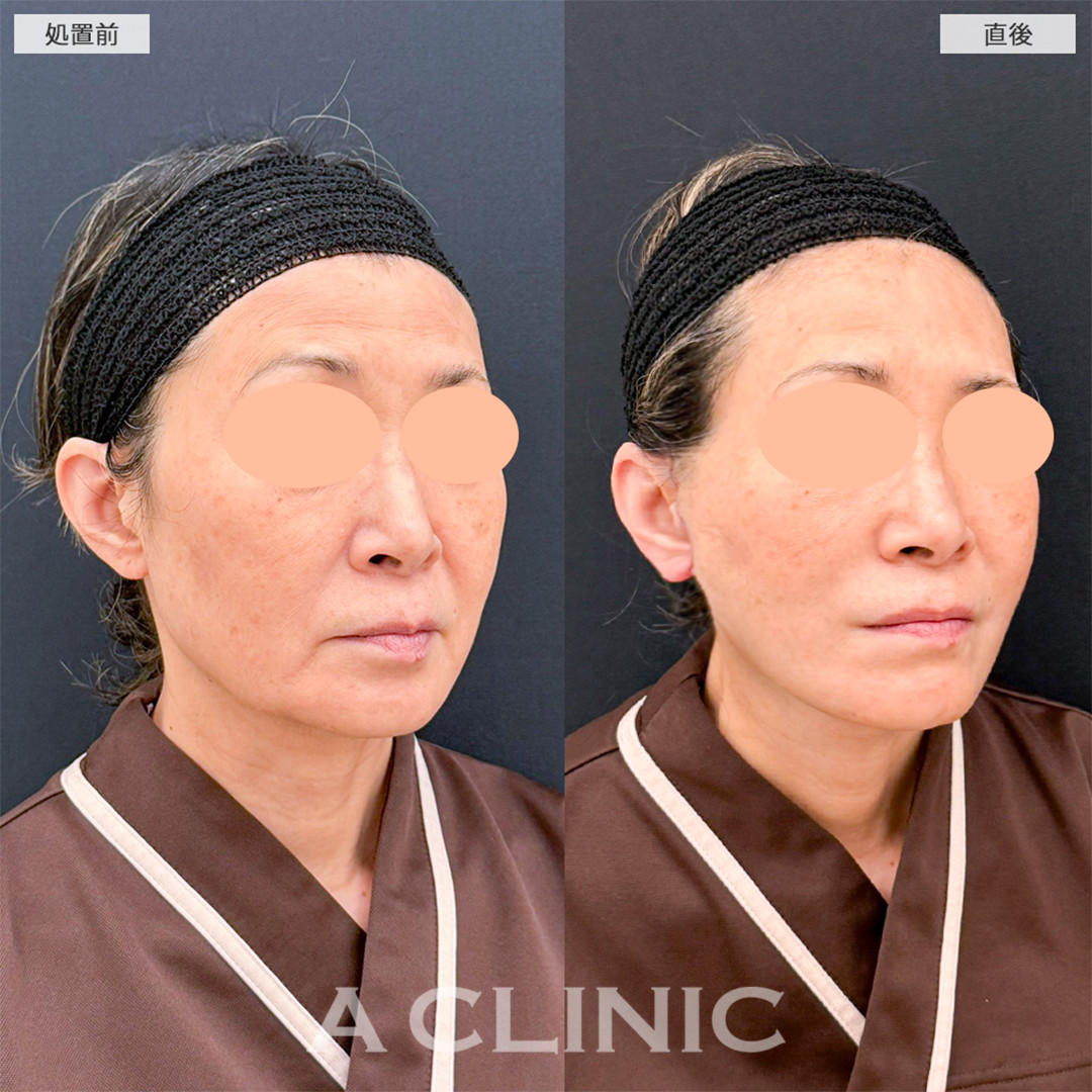 A式たるみ切開で直後から綺麗なフェイスラインになりました！こちら処置前と直後の症例です(60代女性)