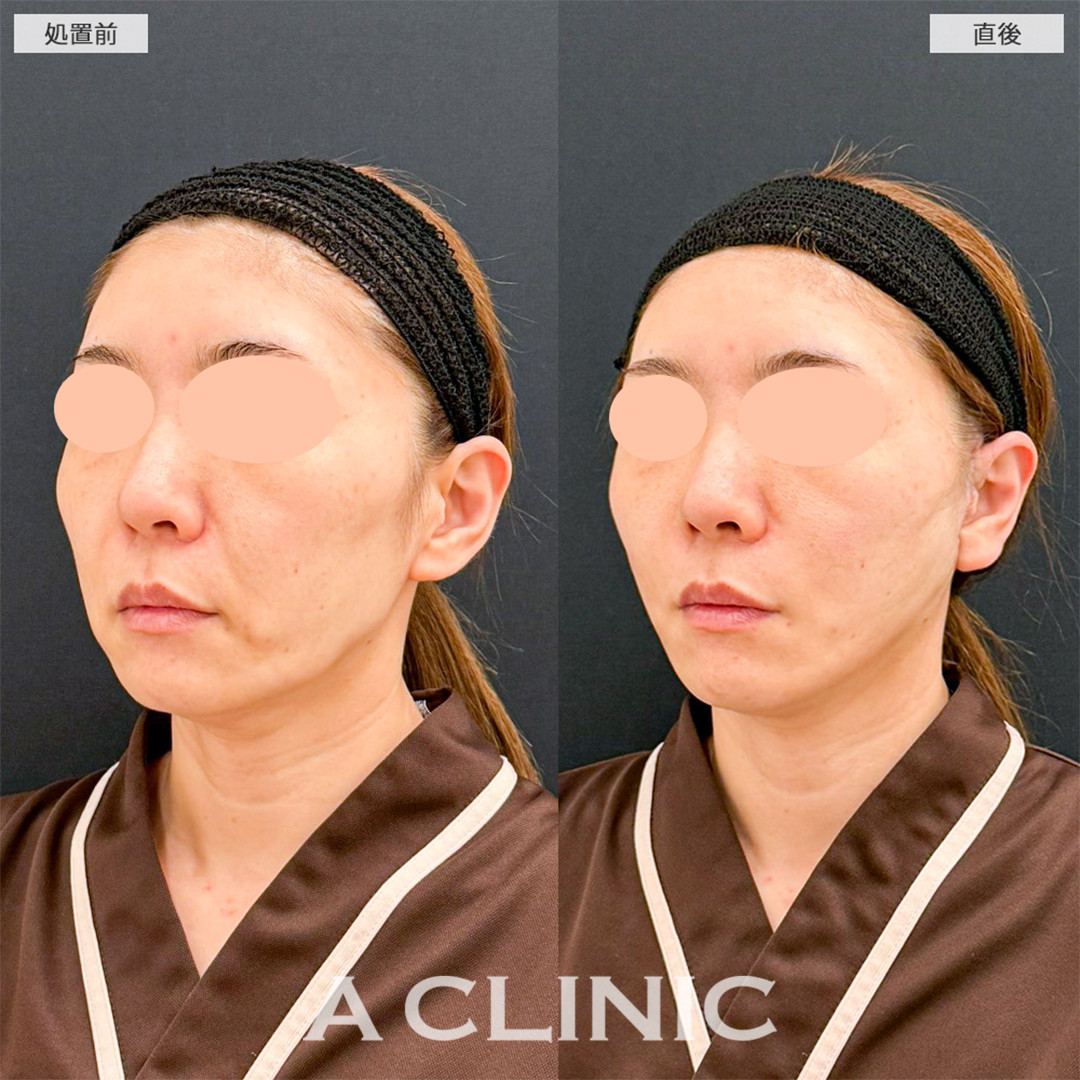 A式たるみ切開は直後からマイナス10歳の若返りが可能です！こちら処置前と直後の症例です(40代女性)