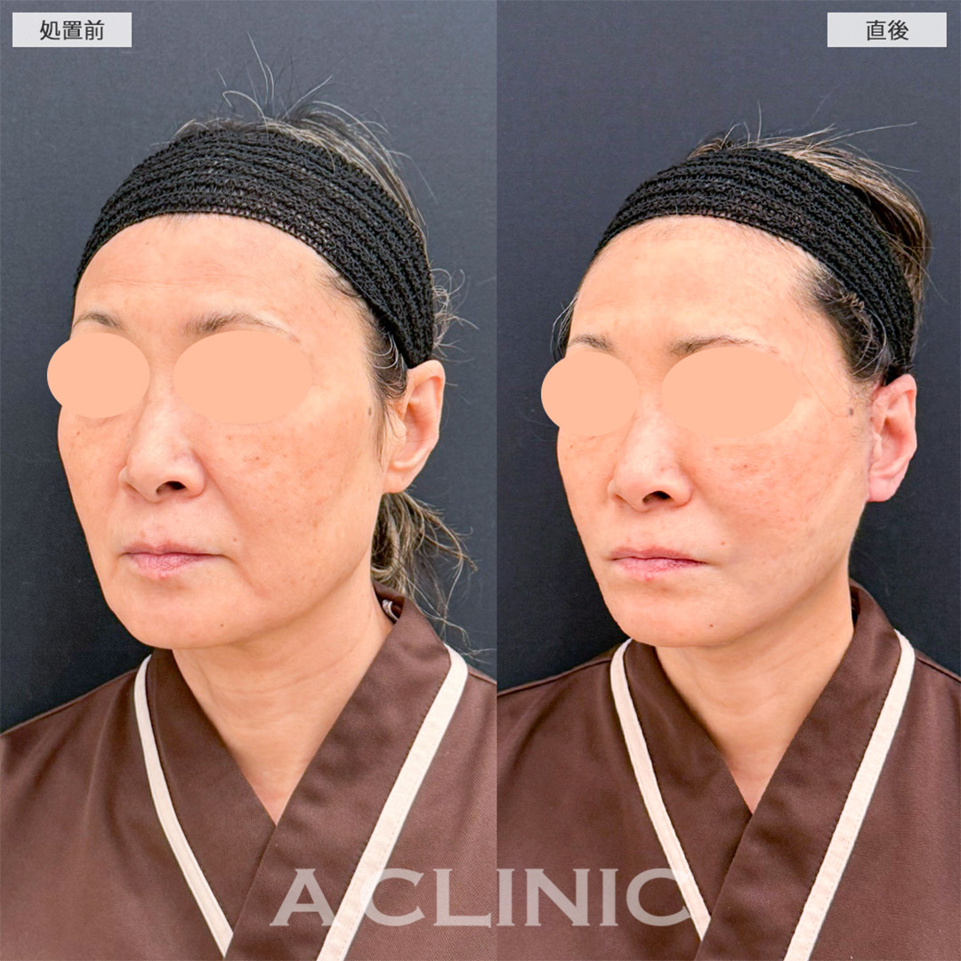 A式たるみ切開で直後から綺麗なフェイスラインになりました！こちら処置前と直後の症例です(60代女性)