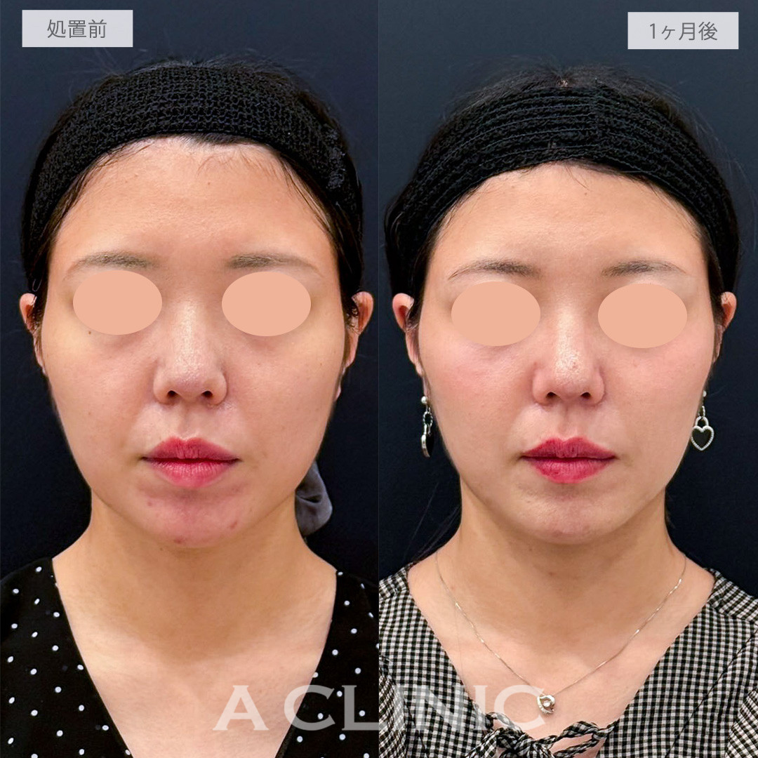 A式トリニティリフトは溶かして引き上げる小顔形成術です！こちら処置前から1か月後の症例です(20代女性)