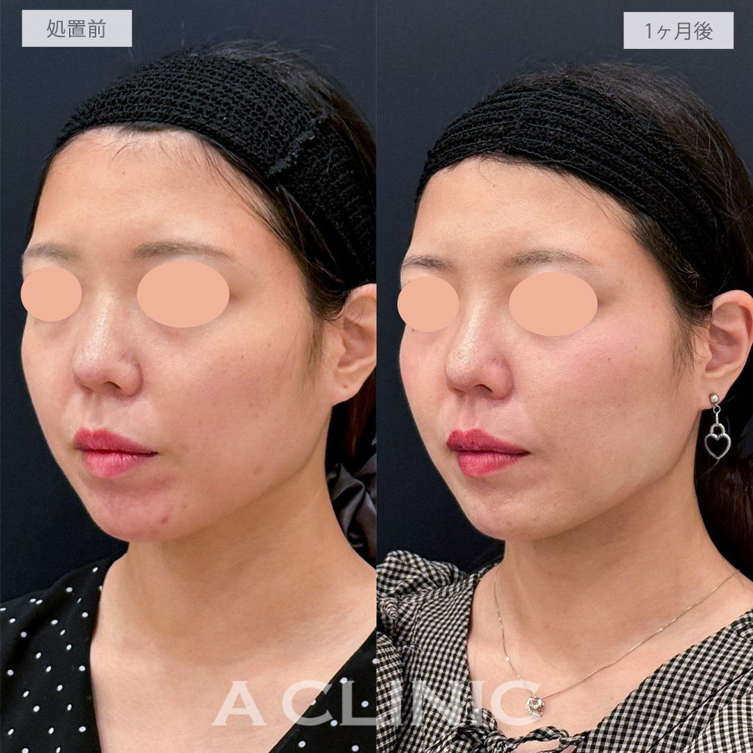 A式トリニティリフトは溶かして引き上げる小顔形成術です！こちら処置前から1か月後の症例です(20代女性)