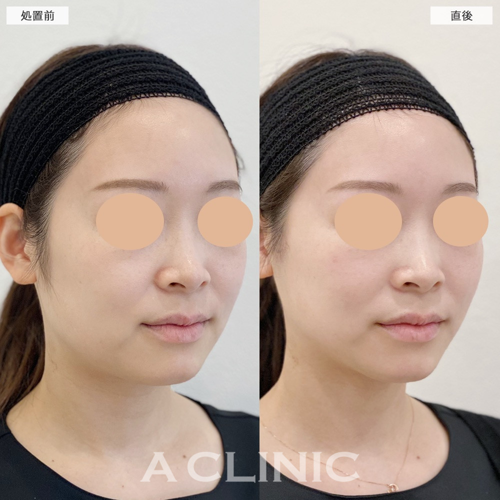 A式トリニティリフトで切らずにすっきり小顔印象へ！こちら処置前と直後の症例です(20代女性)