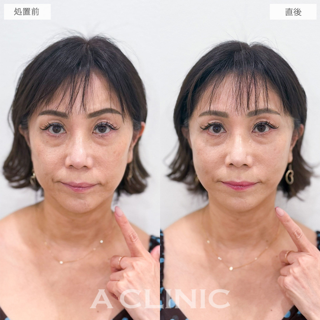 AスレッドとXERF(ザーフ)でつるんとハリのある印象の輪郭になれました！こちら処置前と直後の症例です(50代女性)